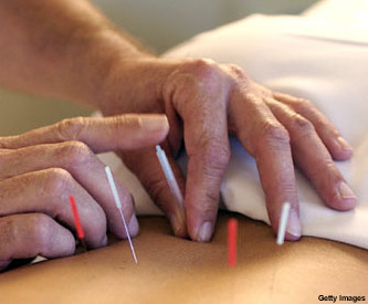 Una revista médica alerta del riesgo de la acupuntura